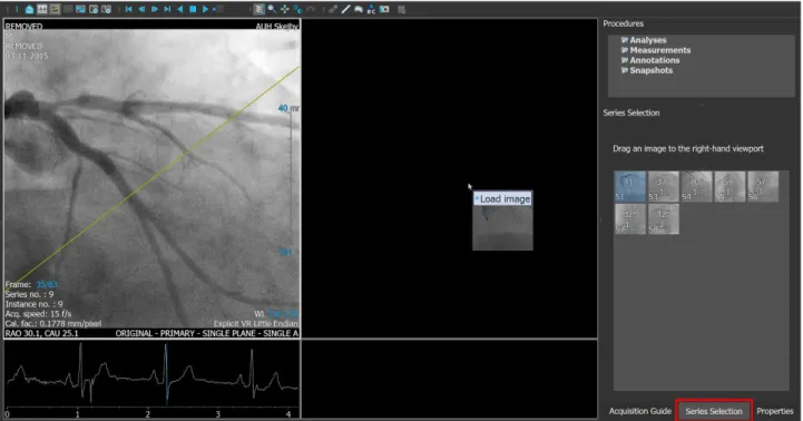 Figure 4 Angiographic run selection. Red box: Series Selection.  