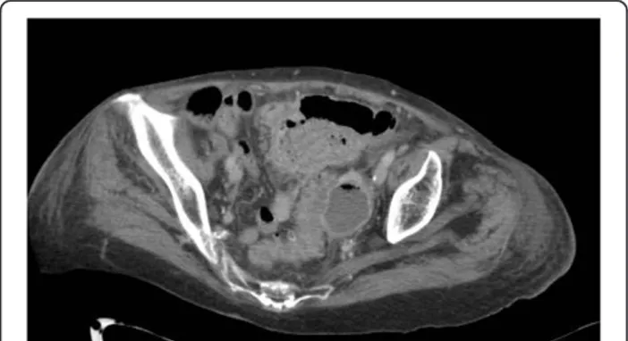 Figure 4 Sigmoid diverticulitis with associated abscess formation.