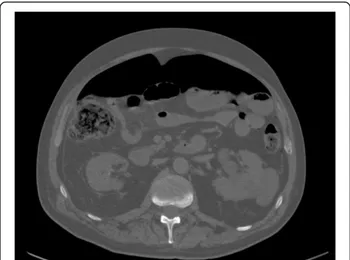 Figure 7 Distant free air in patient with diverticulitis perforation.