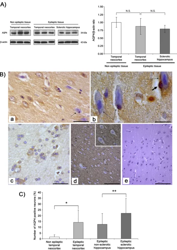 Fig. 4. Western blotting and immunohistochemical localization of AQP4 in epileptic tissues