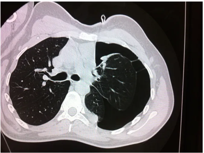Figure 4.  Left-sided pneumothorax due to the collision.