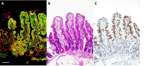 Figure 1. Other represen- represen-tative photomicrographs illustrating IgA anti-TG2  in-testinal deposits (A,  arrow-heads), side-by-side with histologic (B) and  immu-nohistochemical (C)  ﬁnd-ings of a patient with PCD.