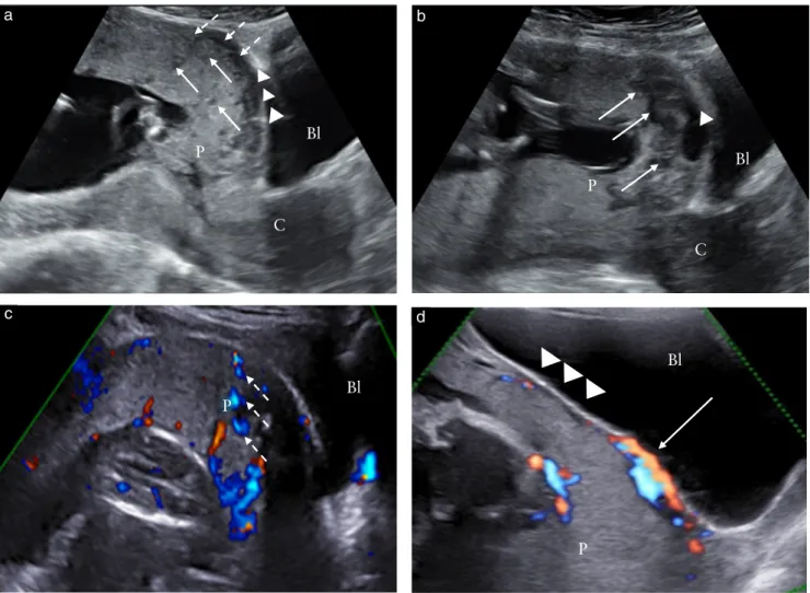 Figure 1 Ultrasound signs of abnormally invasive placenta in first trimester of pregnancy (11–14 weeks’ gestation)