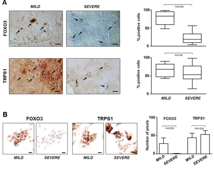 Figure  4.  FOXO3  and  TRPS1  expression  in  IVD  tissues  and  P0  cells. (A)  Immunohistochemistry  on  IVD  tissues  with  MILD  or  SEVERE IDD and (B) immunocytochemistry on P0 cells demonstrating the presence of FOXO3 and TRPS1 (positive cells in re