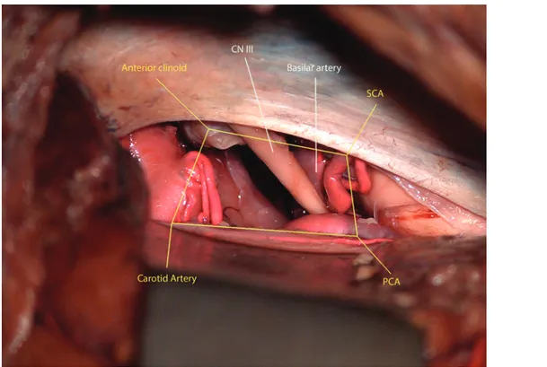 FIG. 2. The target area is shown, which is limited by the anterior clinoid process, SCA, PCA, and carotid artery