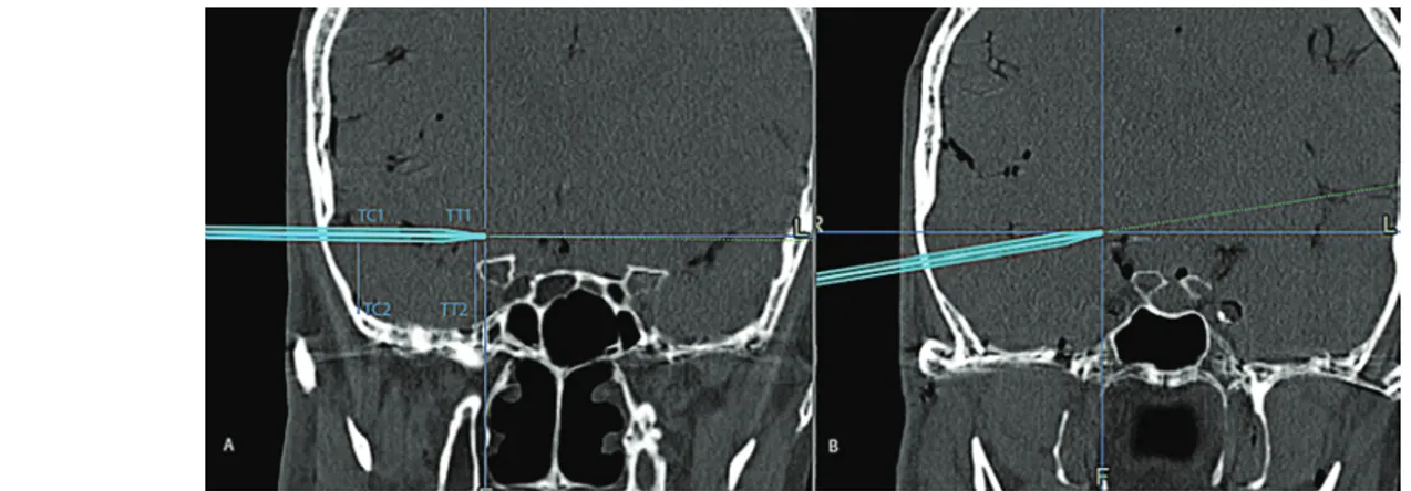 FIG. 3. There were not any significant differences in the medial retraction distance between the approaches