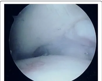 Fig. 1 Arthroscopic view of grade IV cartilage lesion of the talusOsti et al. Journal of Orthopaedic Surgery and Research (2016) 11:37  Page 2 of 7