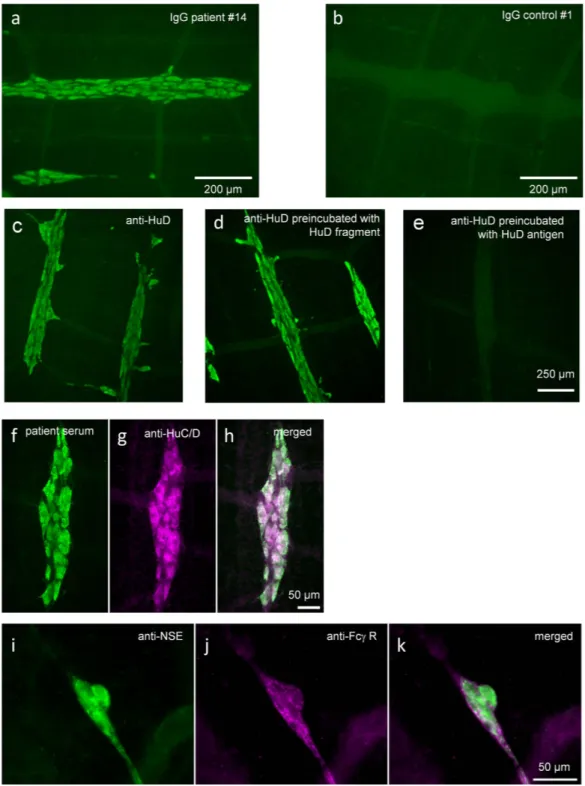 Figure 1.  ANNA-1 sera and purified IgG fractions label guinea pig enteric neurons. Purified IgGs from 