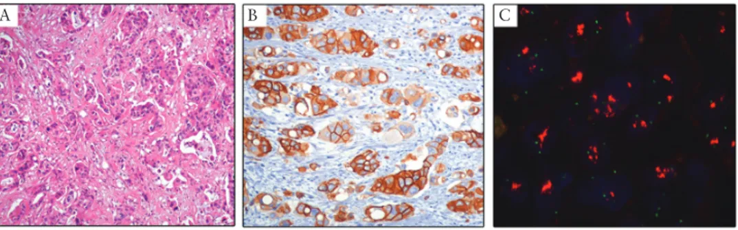 Figure 3.  An example of HER2-positive SBC. Histology of a high-grade SBC [A, original magnification ×200], showing HER2-positive by immunohistochemistry 