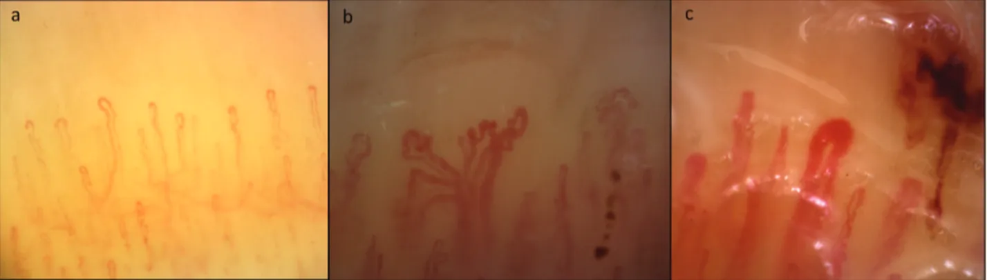 Figure 1. Different morphological patterns on nailfold videocapillaroscopy. A. Raynaud phenomenon (homogeneously distributed capillaries with