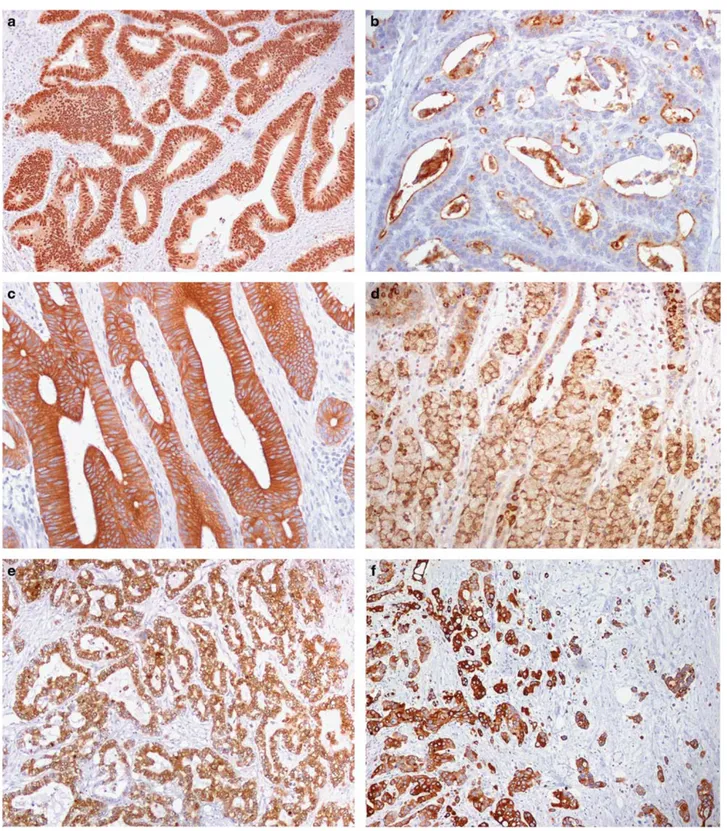 Figure 3 Phenotypic marker expression in small bowel carcinomas. (a) Uniform and intense nuclear positivity for the intestinal transcription factor CDX2 in a glandular-type celiac disease-associated carcinoma