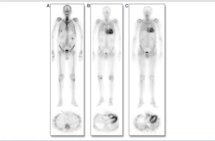 Figure 1. Representative Examples of 99m Tc-DPD Scintigraphy in SSA, ATTR, and HCM