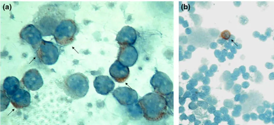 FIG. 3. HHV-6-positive lymphocytes in the cytocentrifuge preparations of peripheral blood mononuclear cells (PBMCs) of individual no