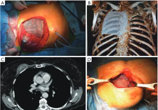 Figure 2 Examples of titanium mesh reconstruction. (A) Anterolateral chest wall reconstruction after chest wall resection for locally  advanced lung cancer; (B) 6-month follow up 3D CT-scan reconstruction