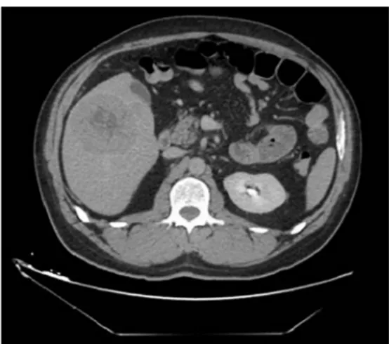 Figure 2 Abdominal TC, multiple liver replicative lesions, the  largest one of 76 mm at the VI segment [2015].