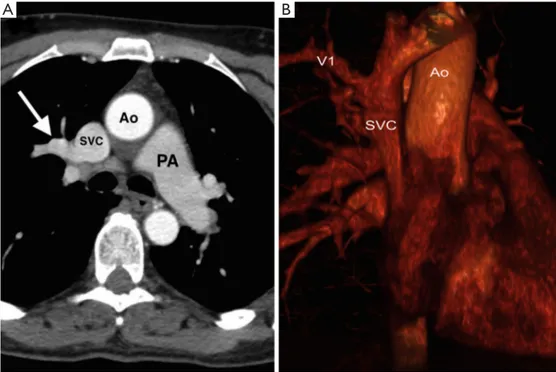Figure 1 CT images. (A) Chest CT scan re-evaluation confirmed the presence of anomalous pulmonary venous return (white arrow) not  previously detected; (B) chest CT scan with 3D reconstruction