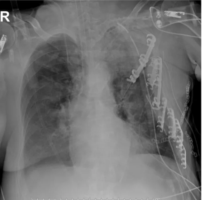 Fig. 3. Post-operative chest roentgenogram showing the left chest armor made of metallic plates.