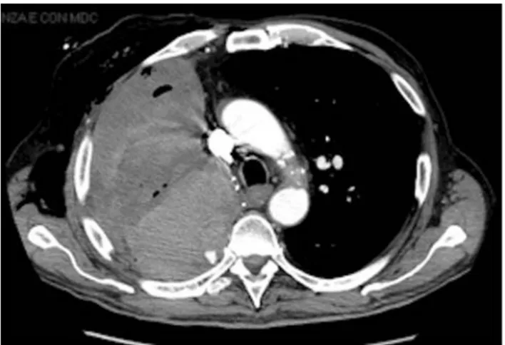 Figure 1: Chest CT performed for weakness, dyspnea and hemoglobin loss, shows the hemothorax due to the intercostal artery leakage