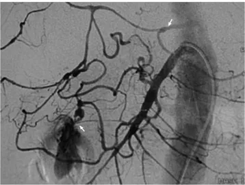 Fig. 2. Selective catheterization and embolization of the pan- pan-creaticoduodenal and superior mesenteric artery arcades supplying the aneurysm.