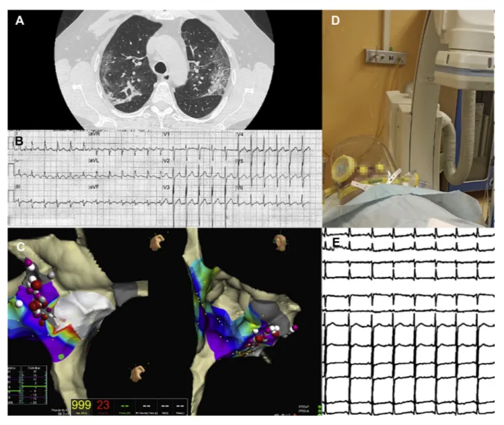 FIGURE 1 Transcatheter Ablation of Atrial Flutter in a Critically Ill COVID-19 Patient