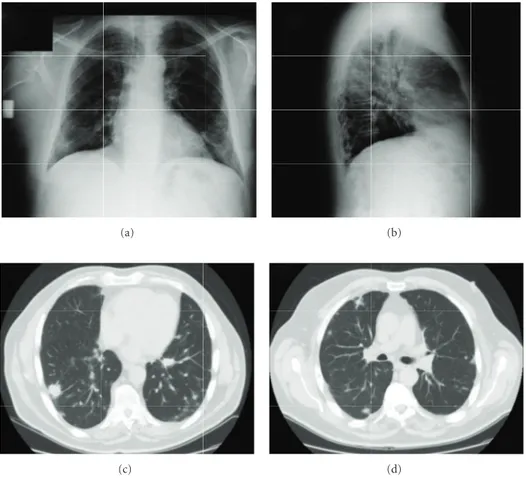 Figure 2: The chest radiography (a, b) and a computed tomography of the chest (performed with iodine intravenous contrast medium) (c, d) showed the presence of multiple bilateral pulmonary nodules.