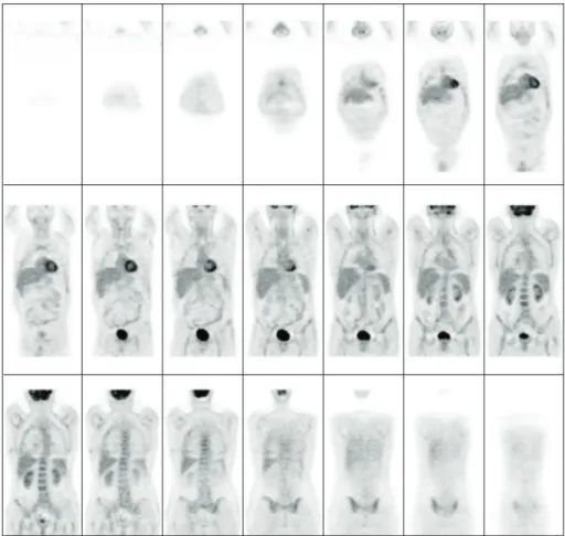 Figure 3: 18F-fluorodeoxyglucose positron emission tomography, all these nodules were not showing any uptake of the tracer.
