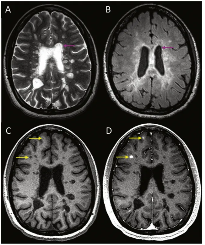 Figure E6. Conventional MR scans show the appearance of MS lesions in the brain. (a) Axial T2-weighted imaging and (b) FLAIR show hyperintense lesions within the white matter
