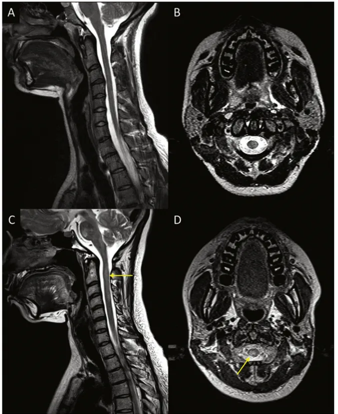 Figure E7. Spine imaging: T2-weighted imaging covering the cervical spinal cord of a healthy control subject (a,b) and a patient with MS (c,d) with spinal lesions