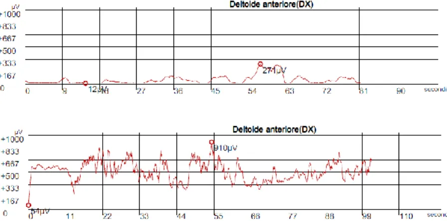 Fig. 21: Esempi di registrazione EMG di superficie del muscolo Deltoide Anteriore nella fase pre- pre-operatoria