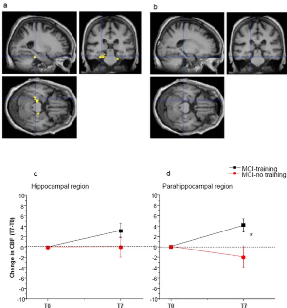 Figure 4.  Train the Brain intervention increases Cerebral Blood Flow (CBF) in Medial Temporal Lobe  (MTL) regions