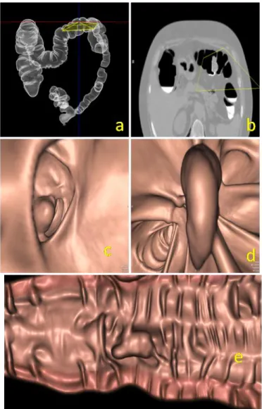 Fig 2: POLIPO ADENOMATOSO : la ricostruzione di volume rendering ( a) non  rileva  anomalie  morfologiche