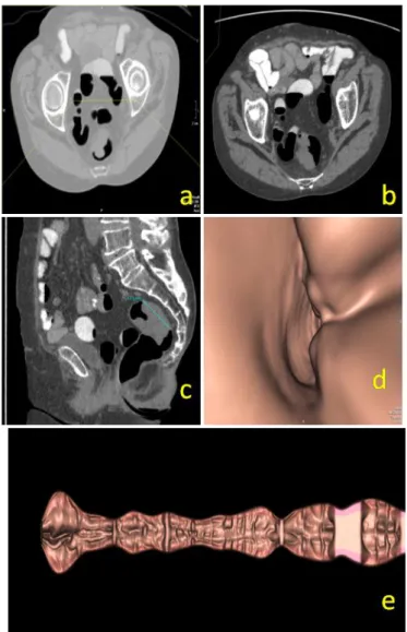 Fig 4: CARCINOMA RETTO-SIGMA  : Le immagini assiali evidenziano tessuto 