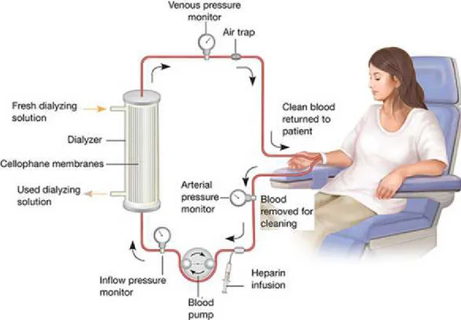 Figure  1.1  -    The  haemodialysis  blood  circuit.  A  dialysis  machine  pumps  blood  from  the  patients, 