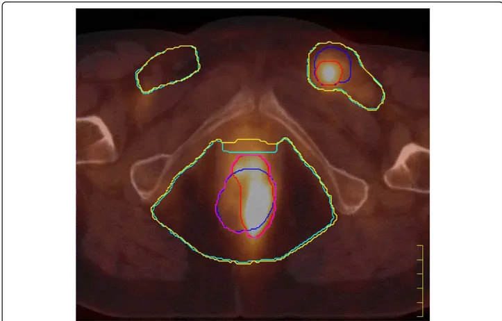 Figure 1 PET/CT image in axial view of a T3N2 case. Different colours are used to highlight the contours of the treatment volumes: CT-GTV (blue), PET-GTV (red), PET/CT-GTV (purple), CT-CTV (light blue), and PET/CT-CTV (yellow)