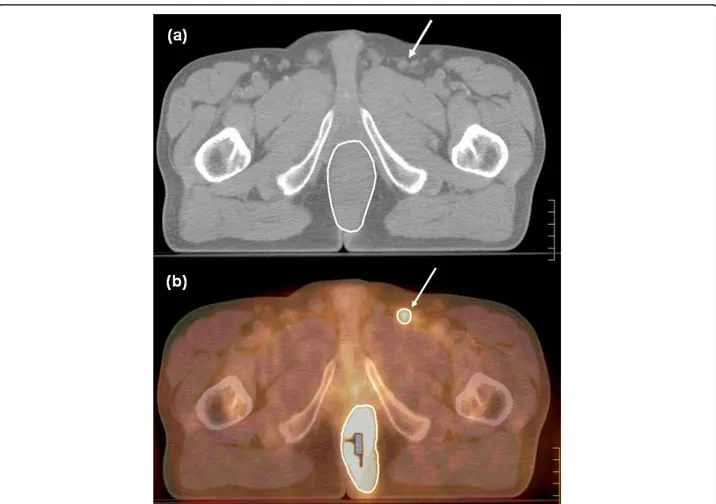 Figure 2 (a – b) CT (a) and PET/CT (b) in axial view showing a lymph node of about 1 cm in diameter with intense uptake at PET (arrows)