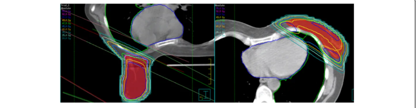 Figure 1 Treatment plans in supine (right) and prone (left) setup.