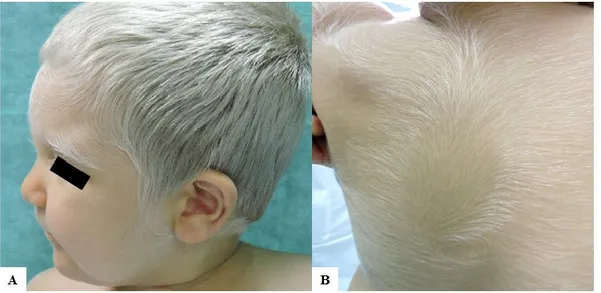 Figure 1. Clinical findings of our patient. (A) A 2-year-old Caucasian child with congenital silvery 
