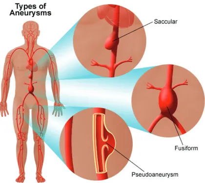 Figure 8. Type of aneurysms (stanfordhealthcare.org)