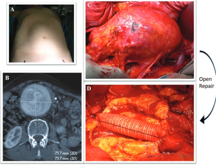 Figure 10. Open surgical repair (A) Abdomen of AAA patient (B) Abdominal CT showing aorta dilatation C) Aneurysm  sac during surgical open repair D) Abdominal aortic graft in Dacron