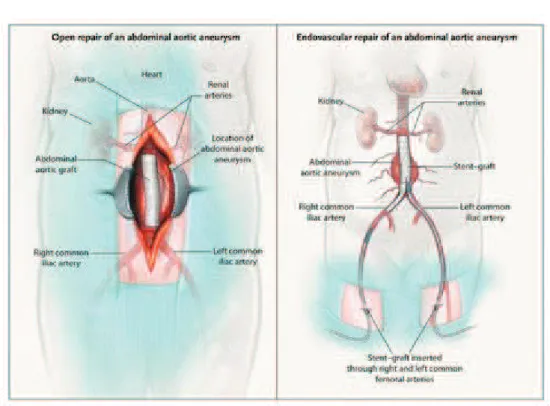 Figure 11. Open surgical repair (A) and Endovascular repair (B). (Schermerhorn et al., 2008) 