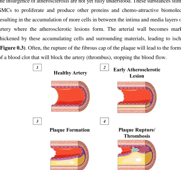 Figure 0.3: Atherosclerosis: Progression of the atherosclerotic lesion affecting an artery