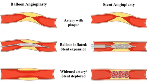 Figure 0.4: Angioplasty: Main steps of balloon and stent angioplasty procedure. 