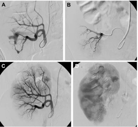 Fig. 1. Endovascular treatment of postbiopsy arteriove- arteriove-nous fistula (AVF). Using contralateral femoral access, selective catheterization of the transplanted renal artery is performed