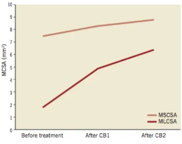 Figure  3:  Increase  in  MLCSA  and  MCSA  of  the  stent  in  four  patients  treated  with  a  two-step  strategy:  first  CB  guided by angiography and second CB guided by OCT (Please note that the increase in CB diameter was 0.5 mm,  achieving an incr