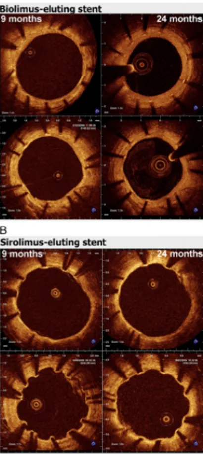 Figure  2  shows  the  evolution  of  coverage  between  9  and  24  months  in  representative cross sections, matched using fiduciary landmarks