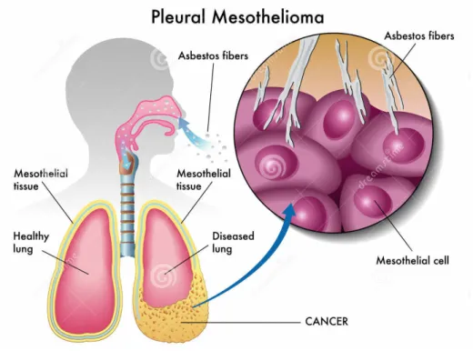 Figure 5.   Development of malignant pleural mesothelioma (MPM) in response to asbestos exposure 