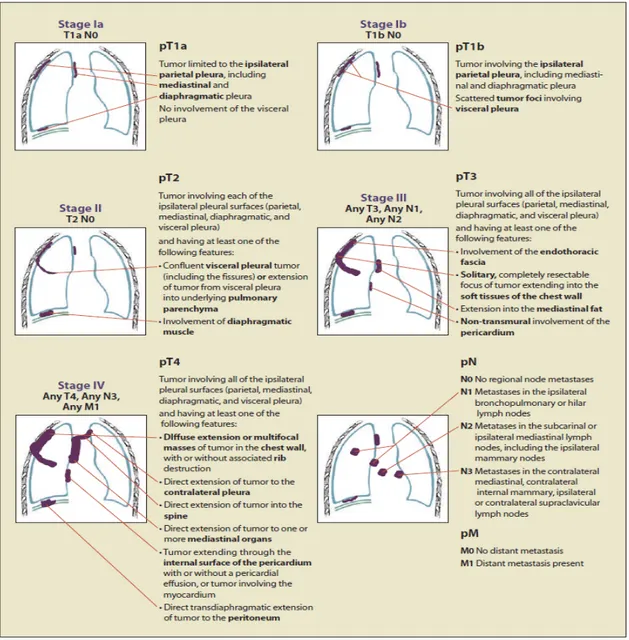 Figure 4  IMIG Staging System for Malignant Pleural Mesothelioma. 