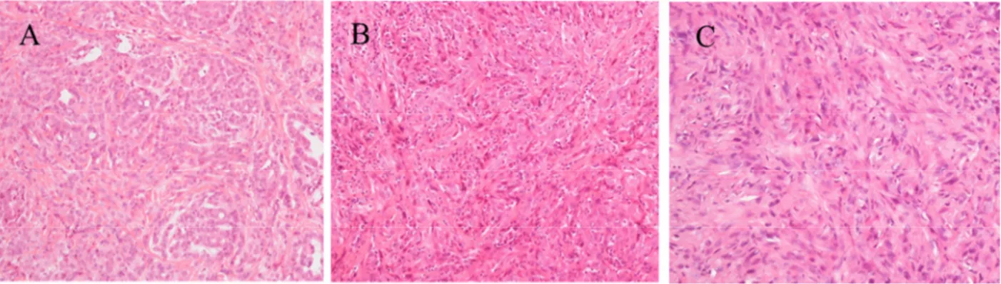 Figure 2 Example of histological subtypes of MPM: A) Epithelioid B) Biphasic C) Sarcomatoid