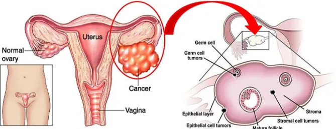 Figure 1: Normal and cancerous ovaries. Types of ovarian cancer originated from different kind of cells of ovaries
