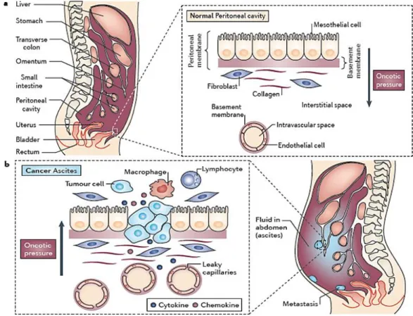 Figure  4: Pathophysiology of  malignant ascite. a) Peritoneal cavity of a normal healthy  person and the peritoneal  membrane covers the visceral organs, as well as the abdominal and pelvic cavities